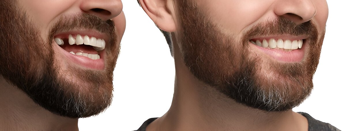 Dental Implants Edmonton